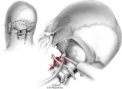 Transcondylar Approach For Resection Of Lateral Medullary Cavernous 