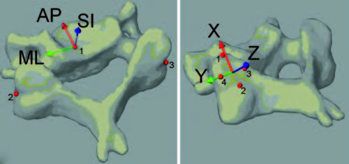 3D motion analysis comparing ACDF with an artificial disc ...