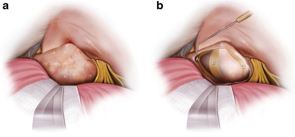 Hearing preservation surgery for vestibular schwannomas via the ...