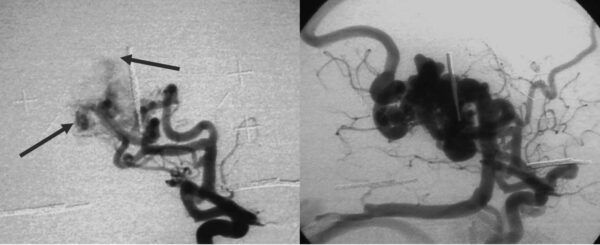 Avm Rash Surgical treatment of brain arteriovenous malformations: clinical ...
