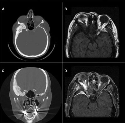 Anterior Clinoid Process Mri