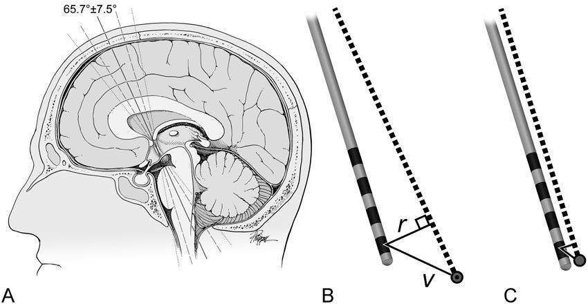 Bilateral deep brain stimulation of the fornix for Alzheimer’s disease ...