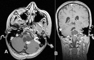 Adult Pilocytic Astrocytoma: An Institutional Series and Systematic ...