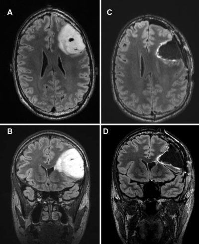 Resection of gliomas deemed inoperable by neurosurgeons based on