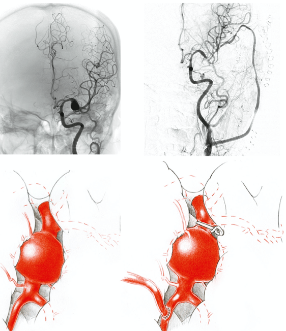 Bypass surgery of complex middle cerebral artery aneurysms—technical ...