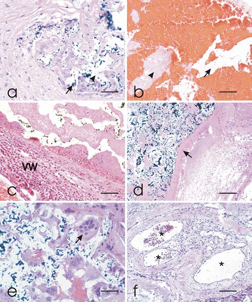 Embolized cerebral arteriovenous malformations: a multivariate analysis ...