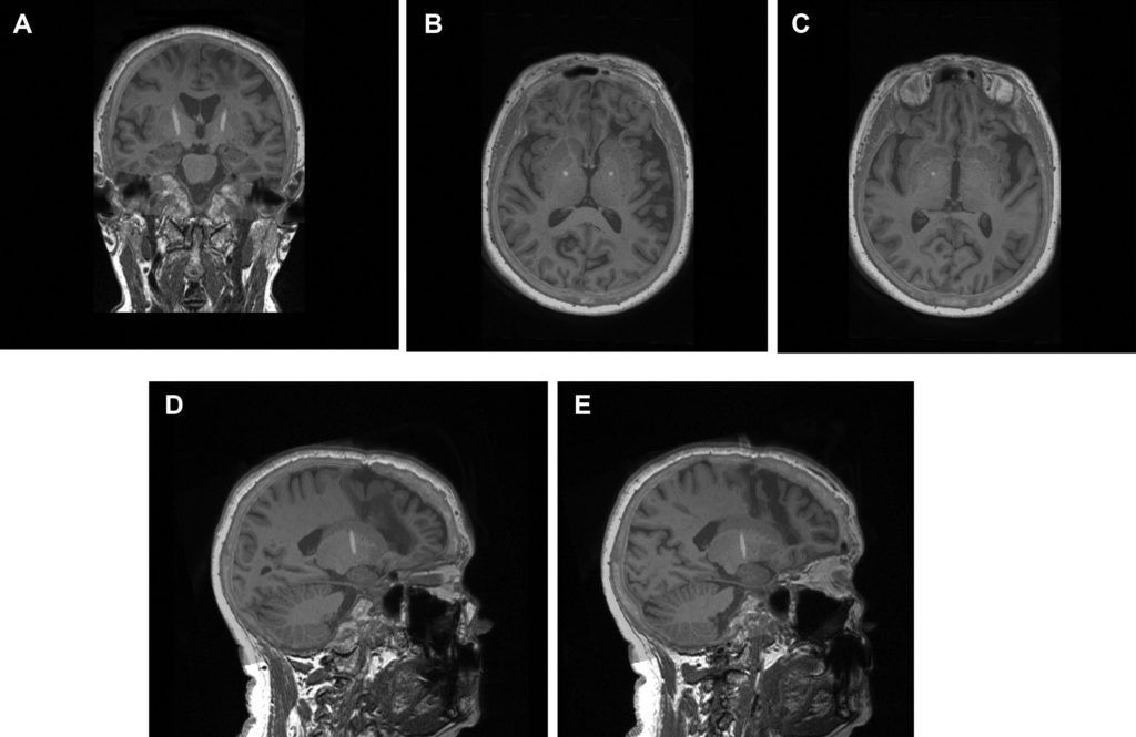 Tractography-Guided Deep Brain Stimulation of the Anteromedial Globus ...