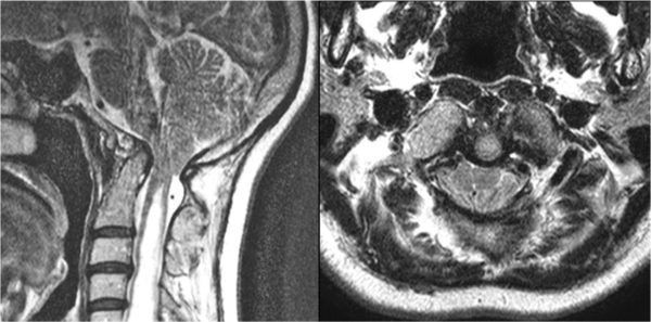 Chiari malformation type I and basilar invagination originating from ...