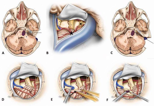 Retrosigmoid transhorizontal fissure approach to lateral pontine ...