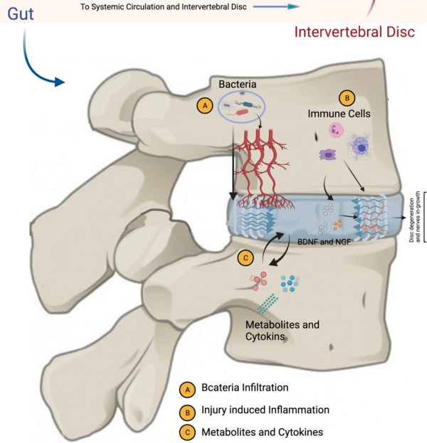 Gut‐disc axis- A cause of intervertebral disc degeneration and low back ...