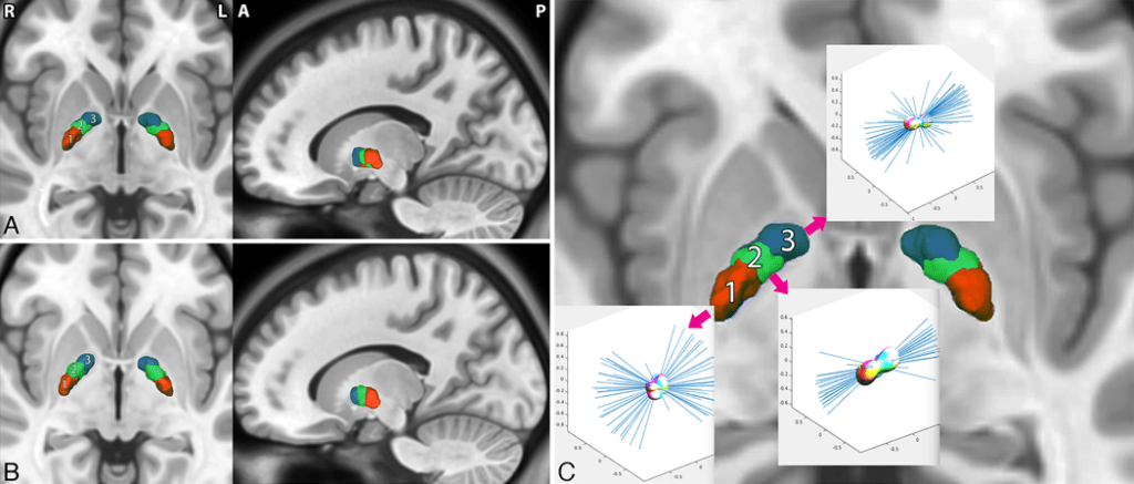 Radiological identification of the globus pallidus motor subregion in ...