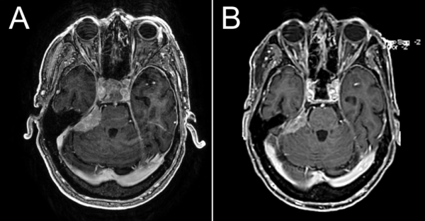 Natural history of meningiomas: a serial volumetric analysis of