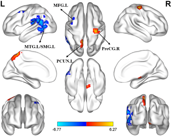Altered brain network centrality in Parkinson’s disease patients after ...