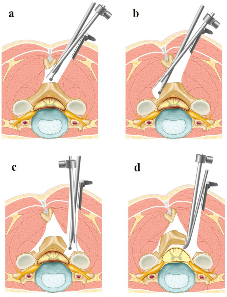 Biportal Endoscopic Cervical Open door Laminoplasty To Treat Cervical biportal-endoscopic-cervical-open-door-laminoplasty-to-treat-cervical