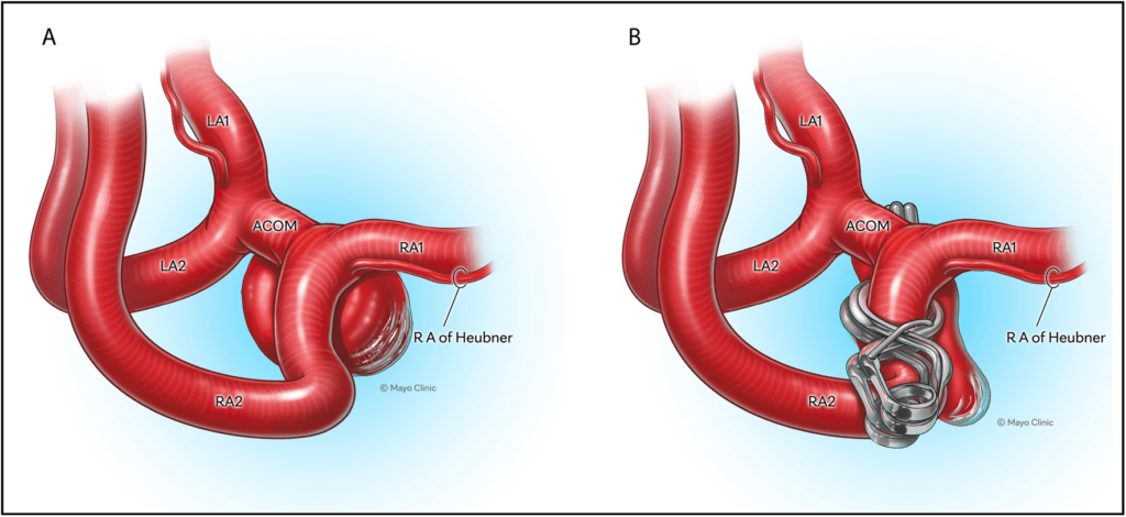 Fenestrated clipping of previously coiled posterior‑superiorly ...