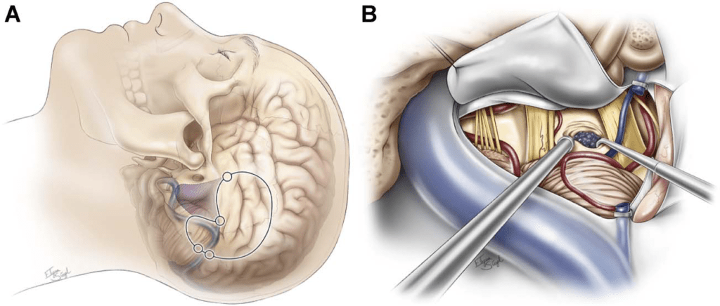One-Point Technique in Brainstem Cavernous Malformation Surgery