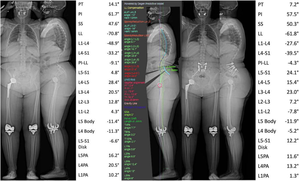 Segmental Sagittal Alignment in Lumbar Spinal Fusion: A Review of ...