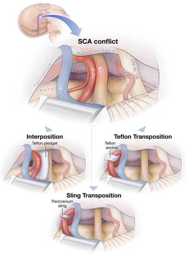 Outcome comparison between interposition and “contactless ...