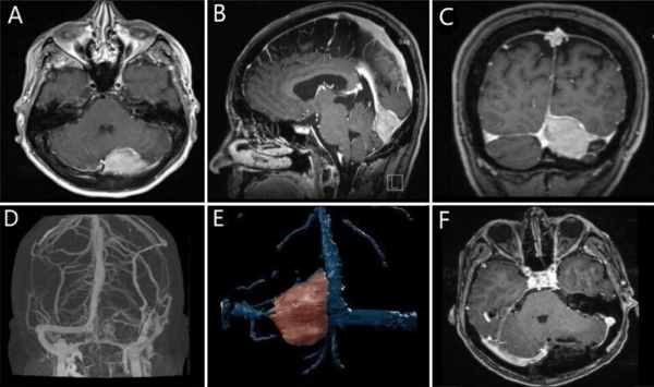 Torcular Inversion Surgery of peritorcular meningiomas: the structural basis for ...