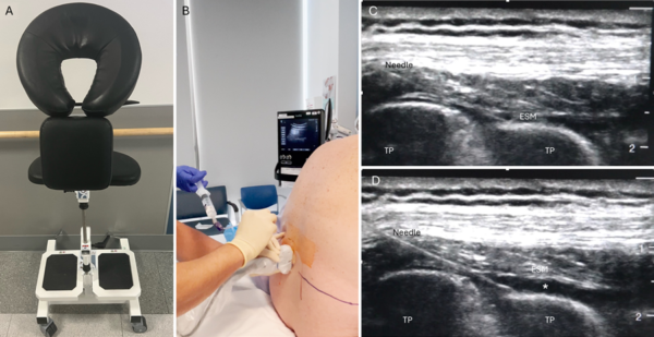 Lumbar Rework Stay Loop Erector spinae plane block during standalone anterior lumbar surgery ...