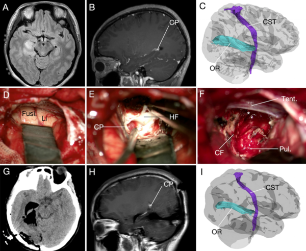 Three-dimensional microsurgical anatomy of the basal aspect of the