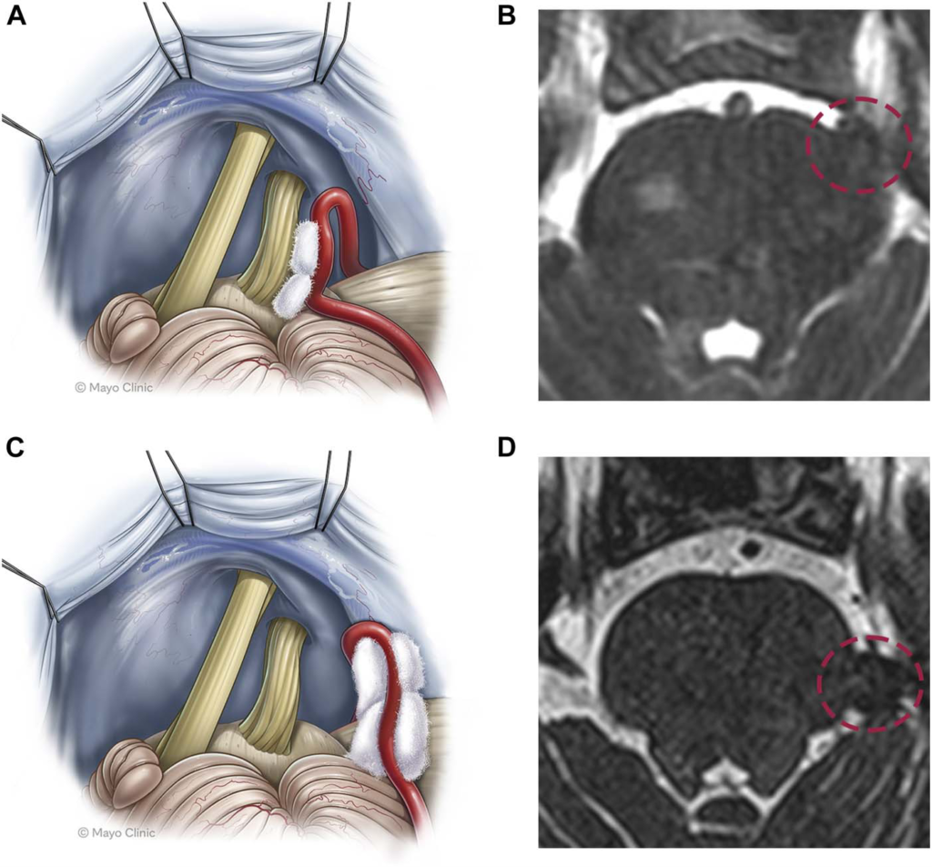 Microvascular Decompression for Patients With Type 1 Trigeminal ...