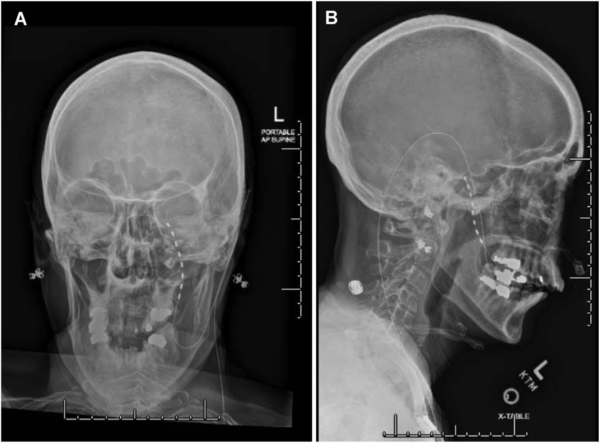 Percutaneous Trigeminal Ganglion Stimulation as a Treatment Modality ...