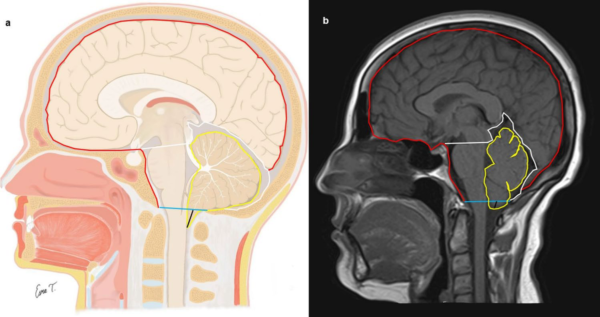 Morphometric assessment of the posterior cranial fossa and its contents ...