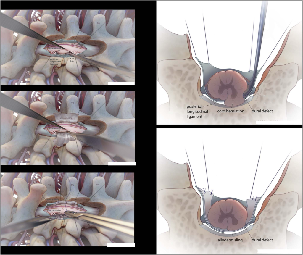 Ventral Ridging Ventral Spinal Cord Displacement: A Guide to Differentiating Spinal ...